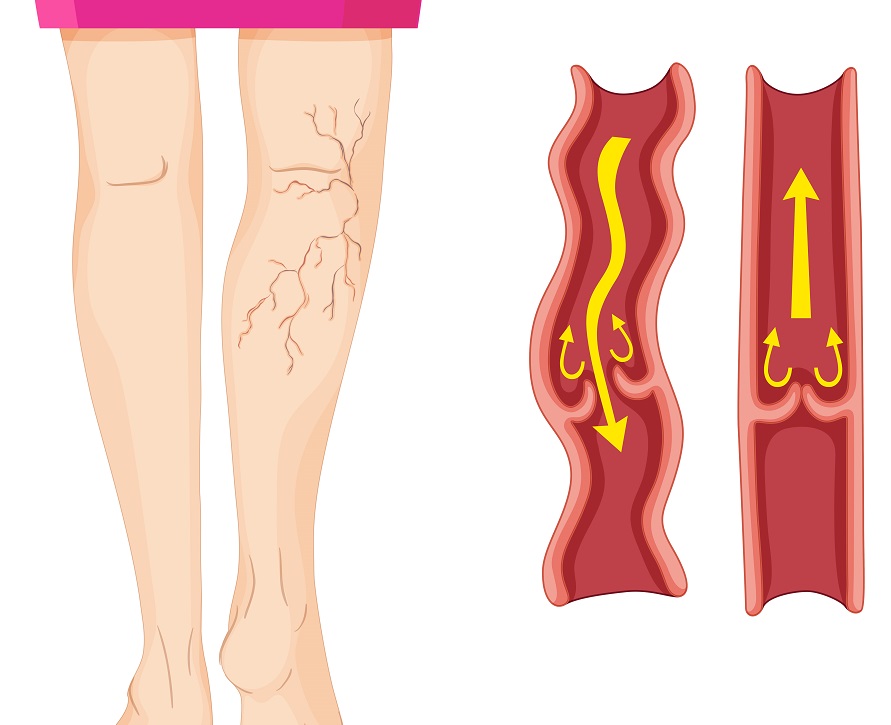 O que é Esofagorragia pós-escleroterapia de varizes