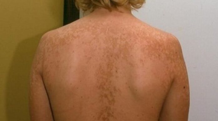 Descubra Tudo Sobre o Pano Preto na Pele