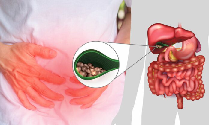 Cirurgia de Pedra na Vesícula