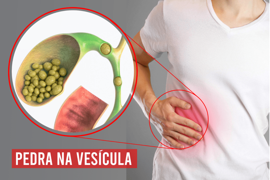 Cirurgia de Vesícula Preço