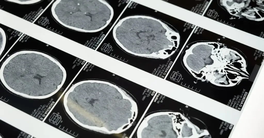 CID Doenças Neurológicas: Entenda a Classificação e Importância