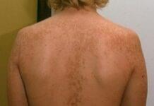 Descubra Tudo Sobre o Pano Preto na Pele